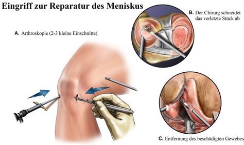 Es gibt hierbei verschiedene rissarten. Meniskusriss im Knie, Schmerzen, Symptome, Operation, Anriss