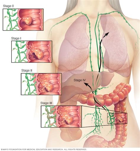 As dogs age, we may want to take chest films as a survey to have a look, just like we do for us sometimes. Colon cancer stages - Mayo Clinic