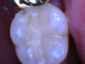 This reduces the number of acid attacks on teeth and gives teeth a chance to repair themselves. How to fix a cracked tooth. - Comprehensive Family Dental ...