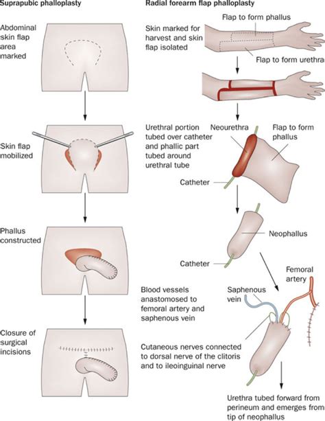 News tagged with sexual transmission. The Procedure of SRS - Sexual Identity and Sex ...