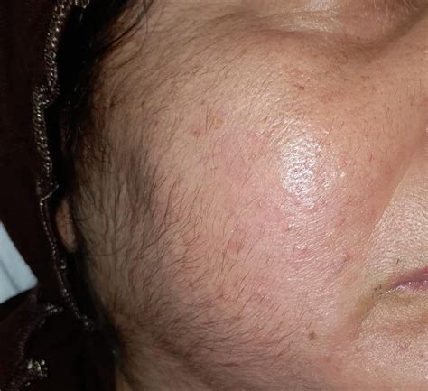 Facial laser hair removal can safely, effectively and permanently reduce the hair, without the harmful effects shaving can have on your skin. Facial Hair in women - Causes and Treatment options - Fever.pk