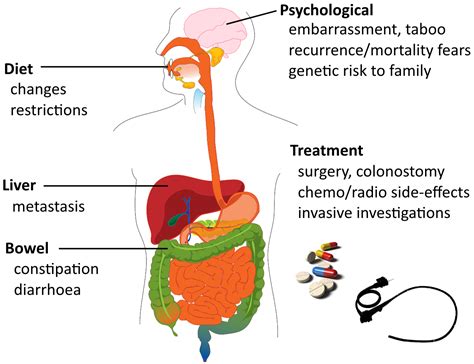 When colorectal cancer is found early, it can often be cured. Colorectal cancer | OverPath