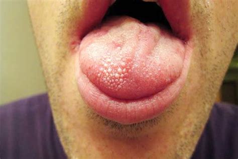 Rinsing and gargling with salt water. Lie Bumps - Causes, Symptoms, Treatment and Prevention