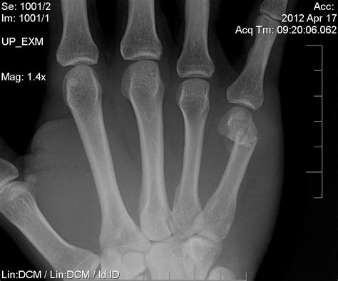 There's a whole lot of information in this article at xrays go through most metals (how much depends on how dense the metal is and how thick). Reddit, I fractured my hand defending a stranger. I don't regret my actions but I'm terrified of ...