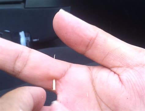 The needles stuck in your skin will rise and be removed with the glue. 11 Hacks on How To Remove a Splinter - Survival Hax
