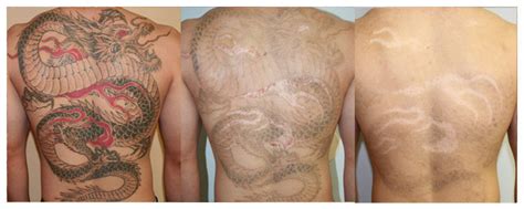 We offer our own proprietary totaltat³ technique, which is a combination of 3 different lasers to remove tattoos more thoroughly and in. Laser Tattoo Removal San Diego - Tattoo Removal Los ...