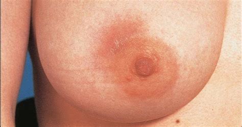 This problem can be mitigated by regularly breastfeeding the baby. Baby Fergusson: Dreaded Mastitis