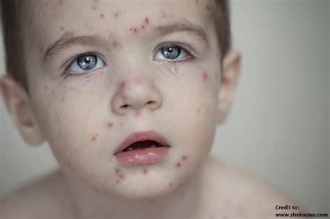 Chickenpox is an infection caused by the varicella zoster virus. Petua Merawat Demam Campak atau Cacar Air/Chicken Pox