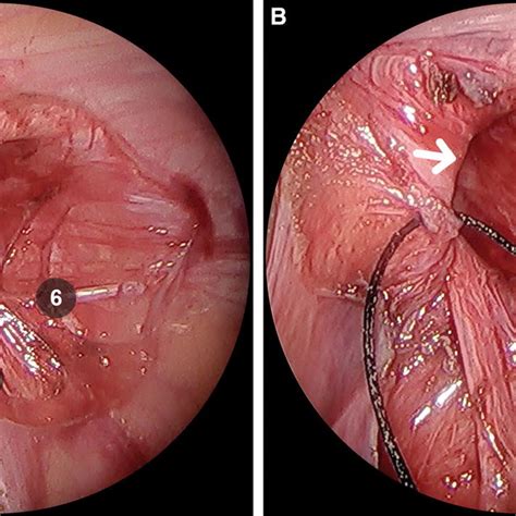 Nearly all hernias can be surgically repaired. Comparison of pain in both the groups | Download Scientific Diagram