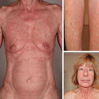 Cutaneous t cell lymphomas represent a heterogenous group of lymphoproliferative disorders defined by clonal proliferation of t cells present in the skin. (PDF) Angioimmunoblastic T-Cell Lymphoma Mimicking Drug ...