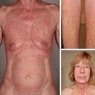 Cutaneous t cell lymphomas represent a heterogenous group of lymphoproliferative disorders defined by clonal proliferation of t cells present in the skin. (PDF) Angioimmunoblastic T-Cell Lymphoma Mimicking Drug ...