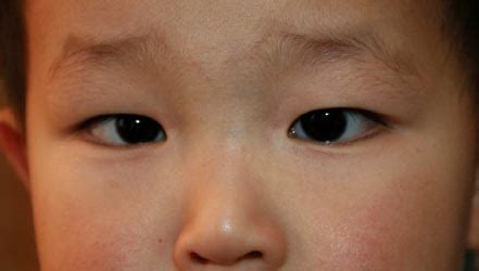 The skin folds at the inner corner of the eyelids are called epicanthal folds and can be broad in some babies. Flat Nasal Bridge And Epicanthal Folds - Facial Features Of Proband Newborn Note Broad Forehead ...