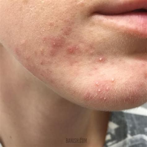 Jun 14, 2021 · hormonal acne tends to present with deep cysts underneath the skin and red, painful papules and pustules on the lower face. HAVE STUBBORN ACNE? HOW TO TELL IF IT'S FOLLICULITIS ...