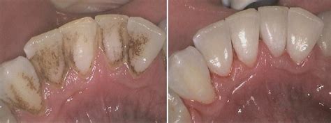 There are 3 known and effective methods of removing stains caused by tobacco and coffee from your teeth. Advanced Hygiene, Stain Removal | Angel Smile