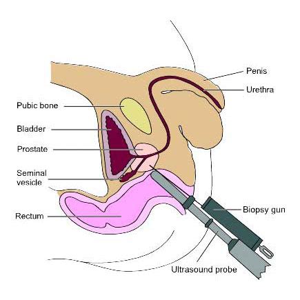 Prostate cancer may not need treatment, depending on how slowly the tumor is growing. What does a PSA test result of 6 mean? - proquestyamaha ...
