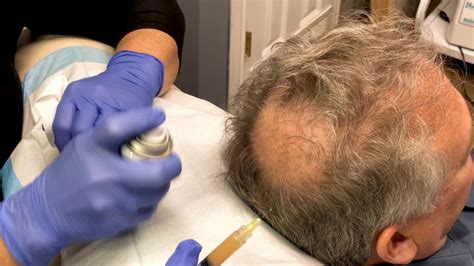 Beyond its tricky pronunciation (no pun intended), it is the compulsive urge to pull out one's hair, which often leads to visible balding or thinning hair. Platelet Rich Plasma Hair Loss Therapy - YouTube