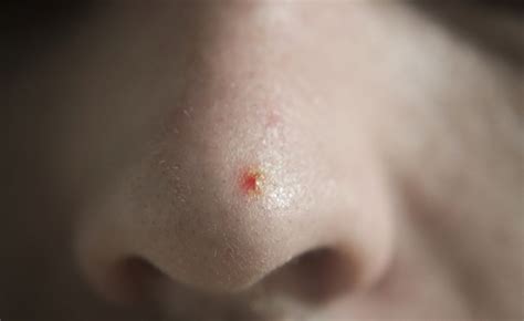 More often than not, people forget to follow basic skincare. Pimples On The Nose - 05 Best Tips To Get Rid Of Them ...