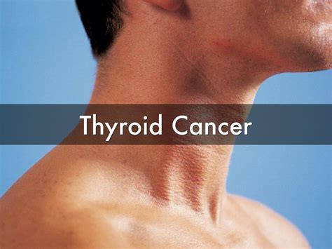 These are the basic stages of head and neck cancer: Thyroid Cancer - Types - Signs, Symptoms, Stages & Treatment
