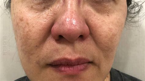 Melasma, rosacea, age spots, and more. Treatments for Uneven Skin Tone and Dull Skin | Peter Ch ...