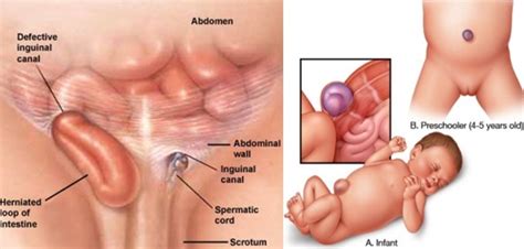 Pada orang dewasa dan anak, hernia yang berlanjut dan tidak mendapat. CELANA HERNIA RECOVERY | OBAT HERNIA ALAMI: Mengobati ...