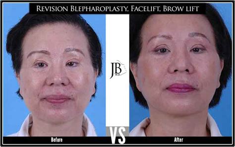 Strenuous activity should be avoided for at least four to six weeks. Asian Facelift | Asian Facial Rejuvenation - Dr. Jose Barrera: San Antonio Facial Plastic ...