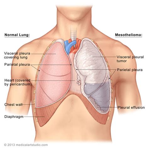 Mesothelioma prognosis, which is the expected progression of the cancer, gives patients a general idea of what to expect after diagnosis and treatment. mesothelioma symptoms: May 2013