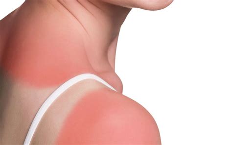 Les coups de soleil sont associés au mélanome, la forme de cancer de la peau la plus dangereuse. Comment soigner un coup de soleil