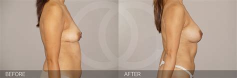 Eine brust op mit implantaten bedeutet für die patientin in den allermeisten fällen ein eingriff mit großem erfolgserlebnis. Körperfetttransplantation mit Eigenfett (Lipofilling ...