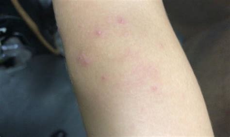 子供の発疹の原因と対処法｜熱なし？かゆい？かゆくない ...