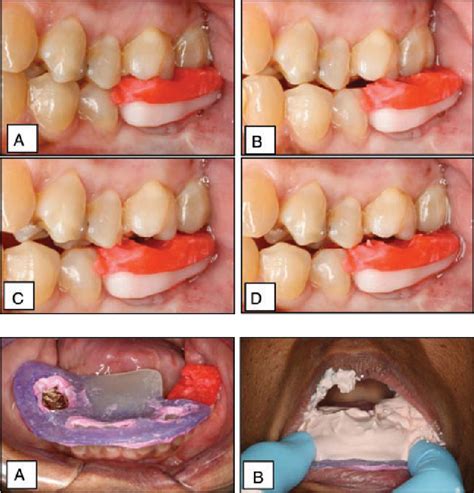 Diagnostic wax up and planning wax up to. Figure 5 from Application of the functionally generated ...