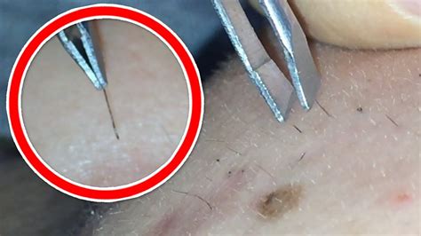 Only ingrown hair removals allowed! ถอนขนคุด ที่ ใบหน้า | Ingrown Hair Removal on My Face EP.1 ...