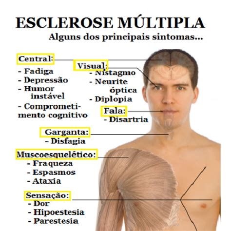 Esclerose múltipla ( em) é uma enfermidade de difícil diagnóstico e caracterizada pelo ataque do sistema imunológico da pessoa ao seu sistema nervoso. Blogão de Fisio: ESCLEROSE MÚLTIPLA (EM)