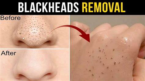 It works as one of the best natural exfoliators. Blackheads removal remedy at home instantly - Memoona ...