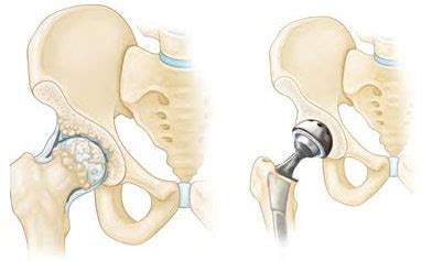 Tears are classified into three grades treatment and recovery. Hip Replacement Recovery Time » How To Relief