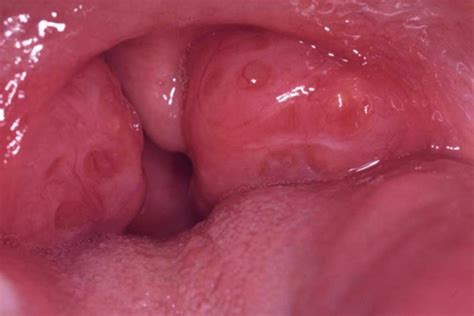 Learn about causes, symptoms, and treatment. Enlarged Tonsils - Pictures, Symptoms, Causes, Treatment ...