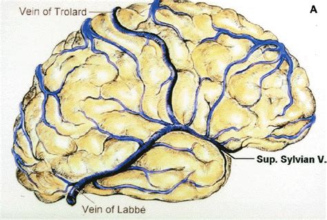 A rich vein of coal; Vena anastomotica inferior (Labbé Vene) - Ars Neurochirurgica