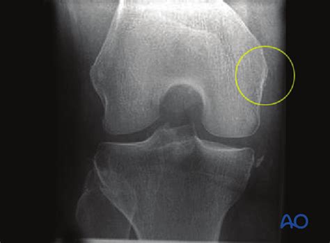 Is the presence of a radiological finding of calcification on the medial side of the knee as a consequence. ORIF lag screw for Lateral/medial femoral epicondyle fracture