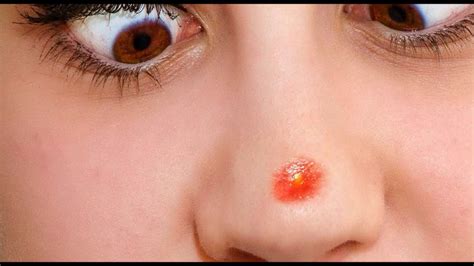 Too much sebum may lead to. Get Rid of Pimples On Nose At Fast - YouTube