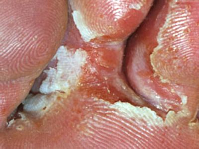Nail fungus is a common condition that begins as a white or yellow spot under the tip of your when fungus infects the areas between your toes and the skin of your feet, it's called athlete's foot (tinea. Effective Methods of Treatment Fungus between Toes ...
