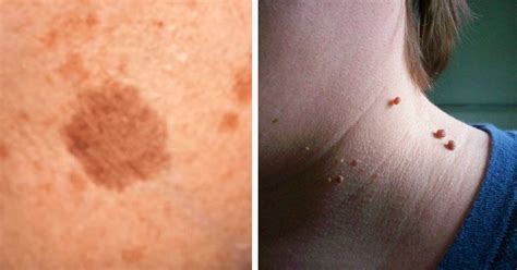 How to remove a plantar wart at home, compound w freeze off wart removal system used on my foot. Ways To Naturally Remove Skin Warts