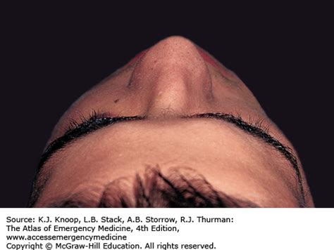 HEAD AND FACIAL TRAUMA | Anesthesia Key