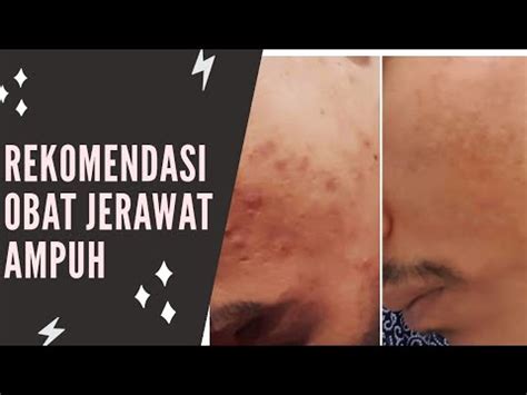 Untuk melawan masalah jerawat di kulit wajah, bisa dilakukan dengan sangat mudah, men. PRODUK AMPUH UNTUK MENGHILANGKAN JERAWAT - YouTube