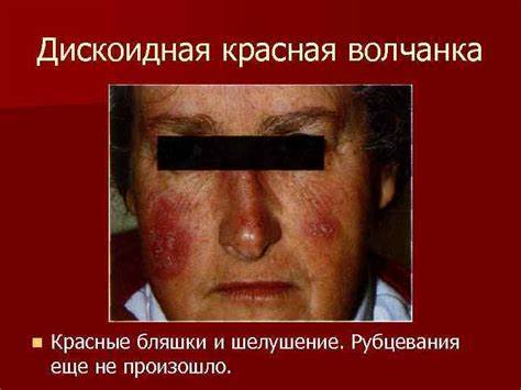 Диета при дискоидной красной волчанки ГОУ ВПО АГМА кафедра дерматовенерологии ТЕМА Красная волчанка ГОУ ВПО АГМА кафедра дерматовенерологии ТЕМА Красная волчанка Диета при дискоидной красной волчанки