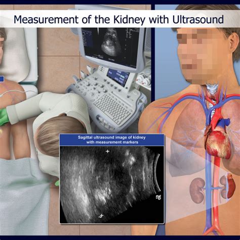 Is it a risky business? Measurement of the Kidney with Ultrasound - TrialExhibits Inc.