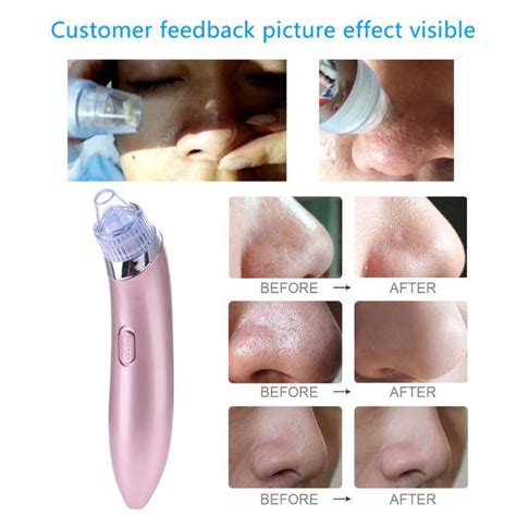 Android top is providing all versions of skin tools pro and you can download it directly to your phone or any android device for that you should scroll your screen below, where you could see many links to download app. Pro Pore Clean Machine Acne Blackhead Remover Vacuum ...