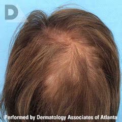 Scalp Micropigmentation | Dermatology Associates of ...