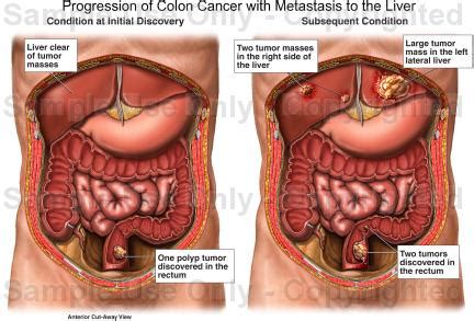 Some of the lesions have grown. Progression of Colon Cancer with Metastasis to the Liver ...