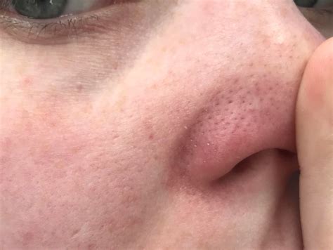 [Skin Concern] Does this look like clogged pores or dry skin ...