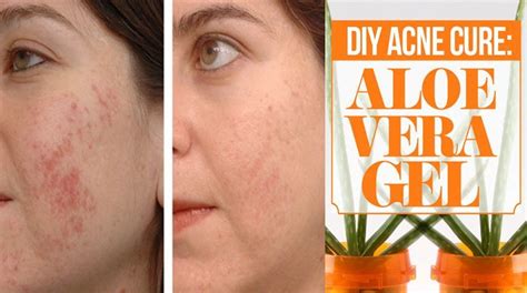 The first is by using chemicals to get rid of them. Pin on How To Get Rid Of Cystic Acne