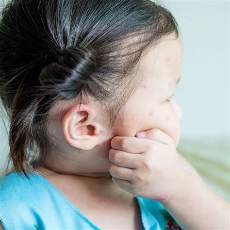 【 赤ちゃんと子どもの発疹の出る病気体験談 】水ぼうそう ...